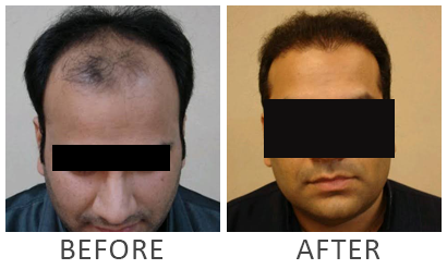 Hair Transplantation | Hair Transplant in Pakistan