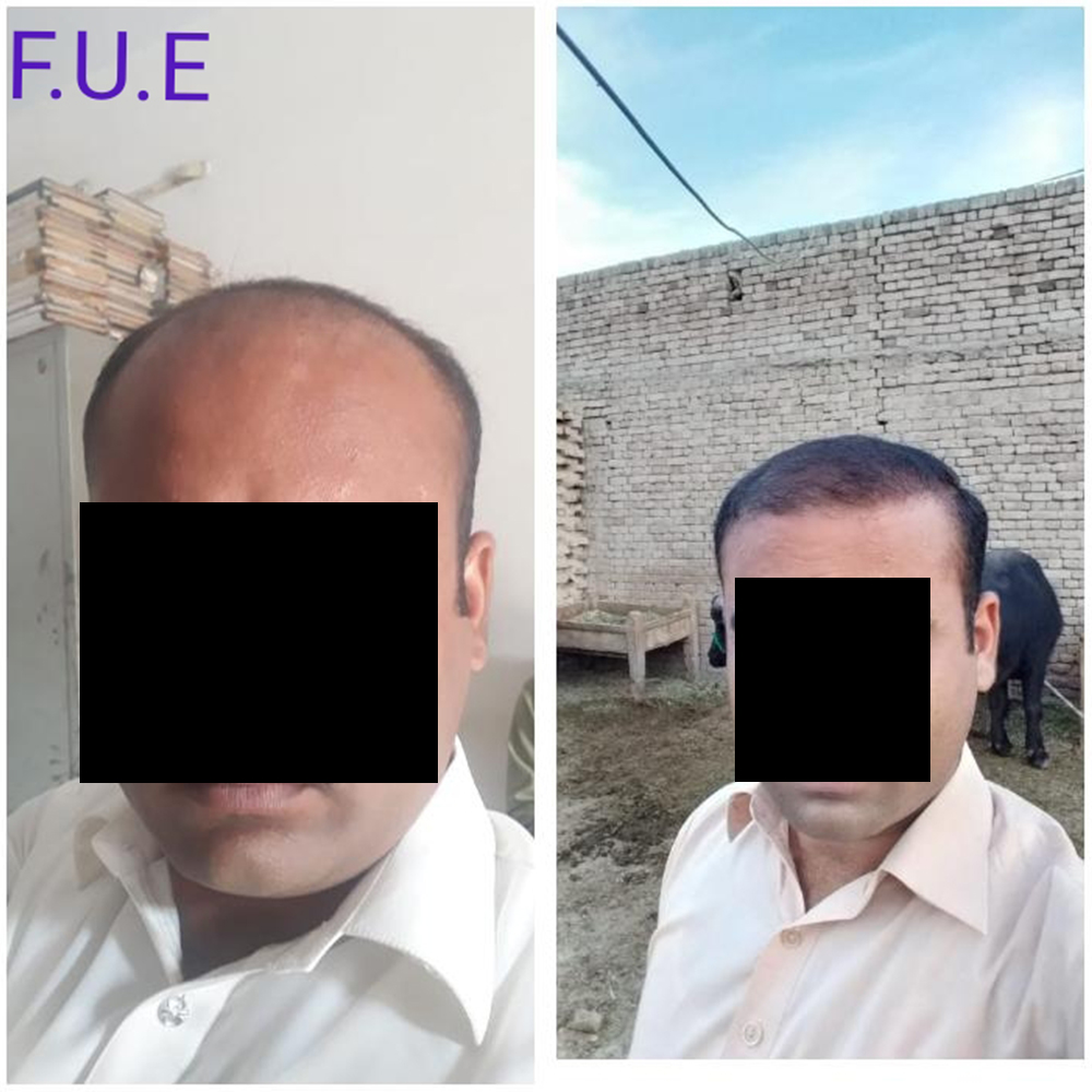 Hair Transplant Procedures in Pakistan By Dr Shehab Mirza Beg