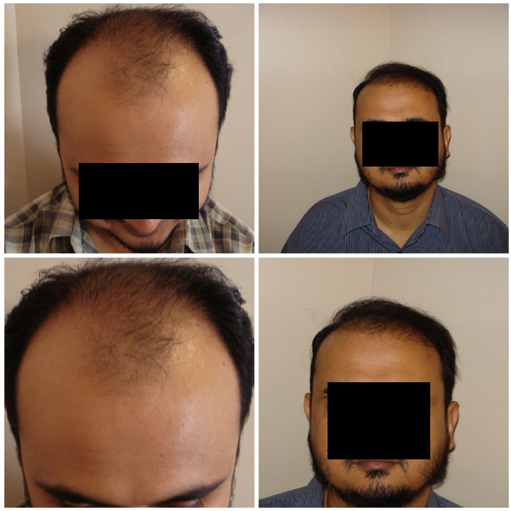 Hair Transplant Procedures in Pakistan By Dr Shehab Mirza Beg