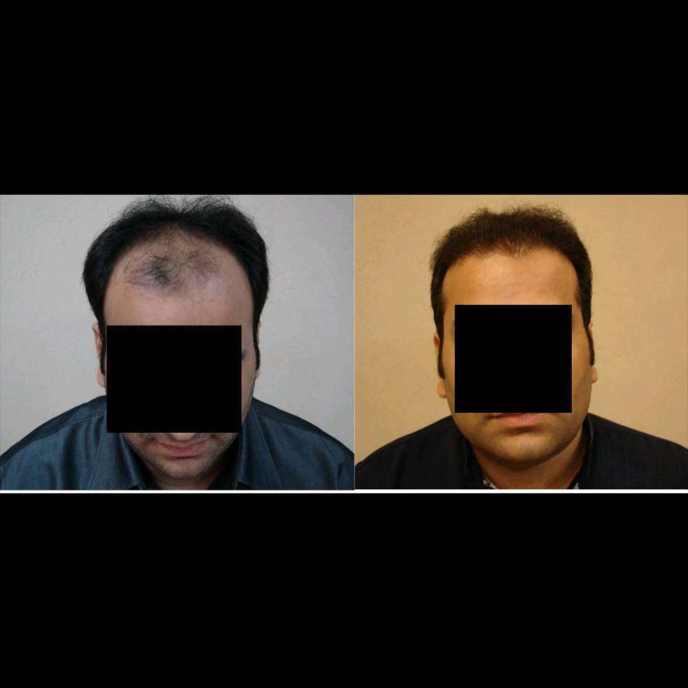 Hair Transplant Procedures in Pakistan By Dr Shehab Mirza Beg