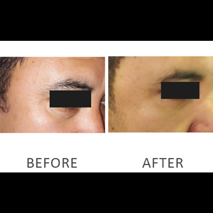 Blepharoplasty Baggy Eyelid In Pakistan