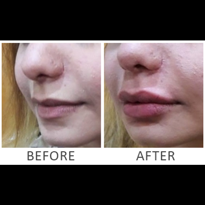 Lip Reduction | Lip Augmentation | Dr. Mirza Shehab Afzal Beg