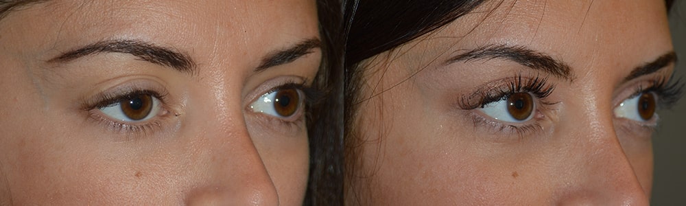 The Ptosis Surgery Procedure